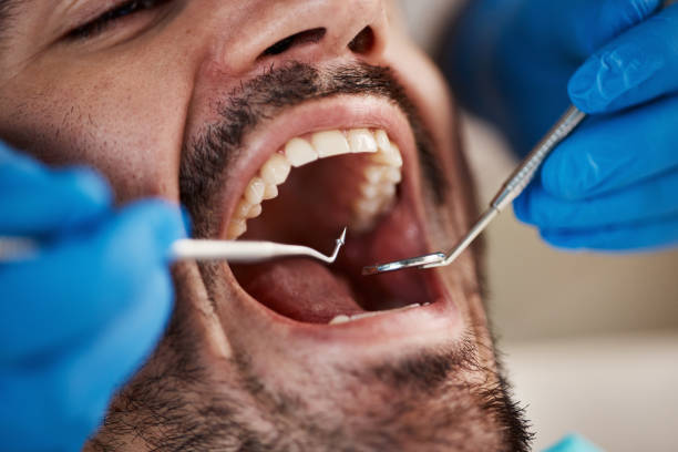 Best Dentist for Tooth Abscess  in Perry, MI